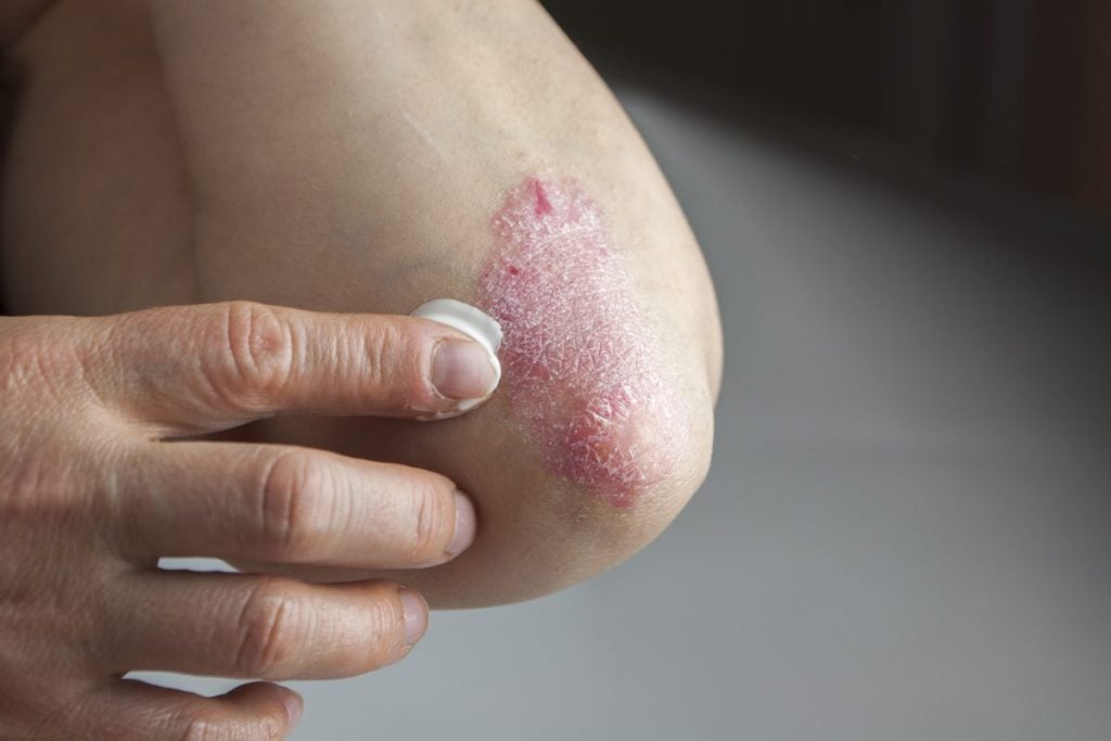 psoriasis
